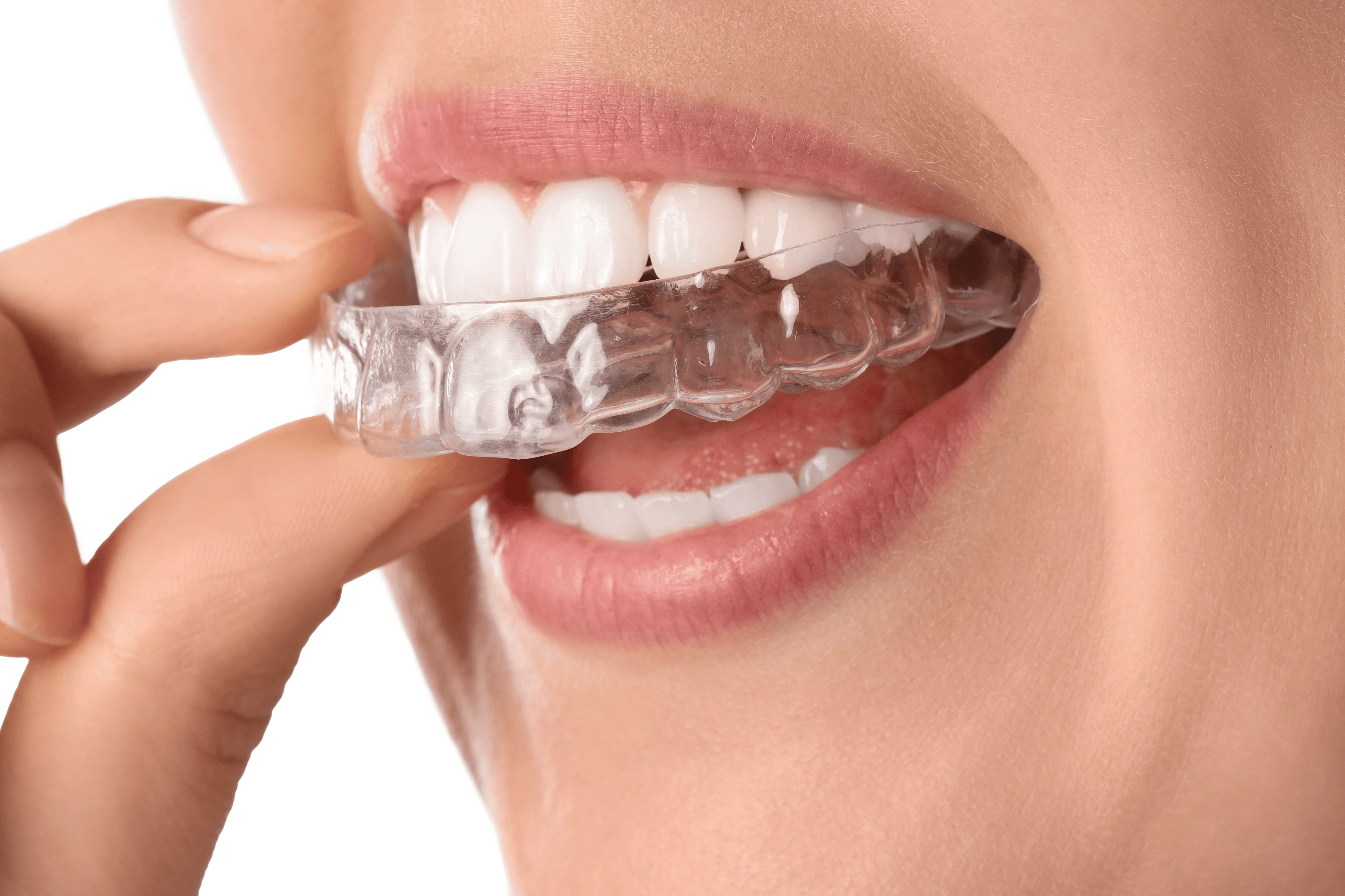 What are Aligners